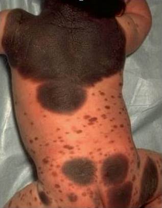 Konjenital melanositik nevüs